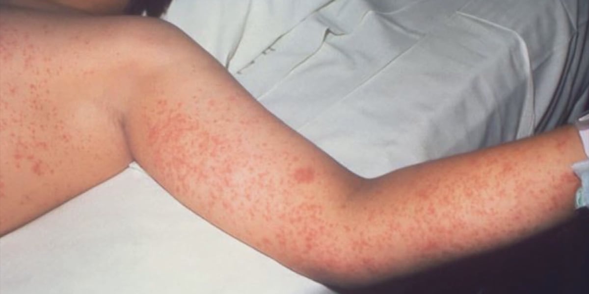 LDH confirms measles case in Greater New Orleans
