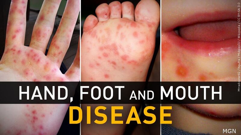 Hand, foot and mouth disease